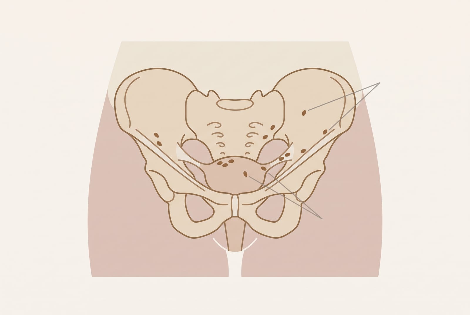 Ilustração explicativa da endometriose