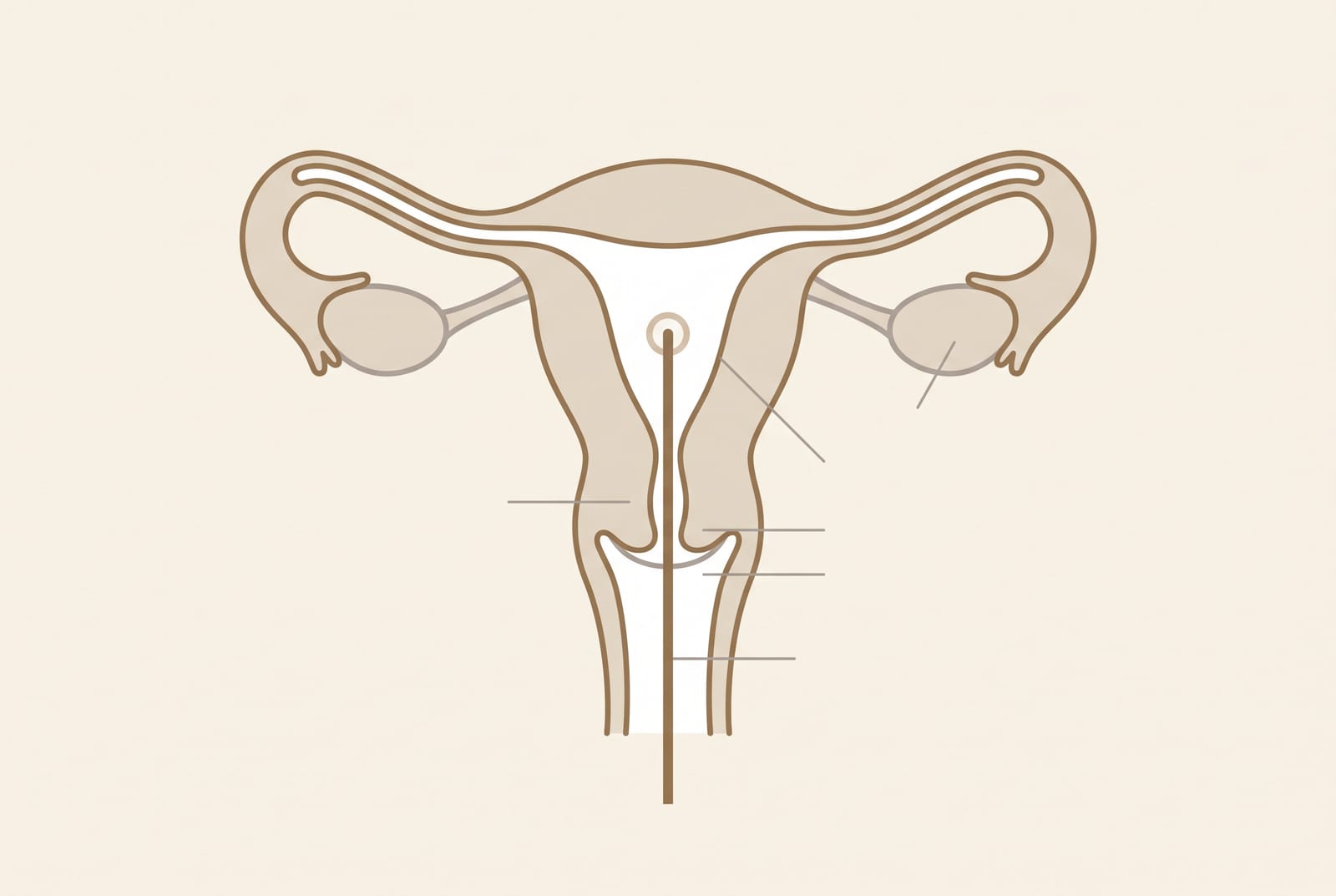 Ilustração explicativa do procedimento de histeroscopia