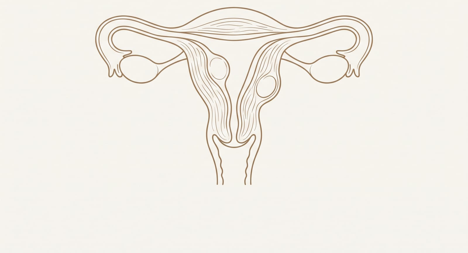 Ilustração explicativa do tratamento cirúrgico dos miomas uterinos (miomectomia)