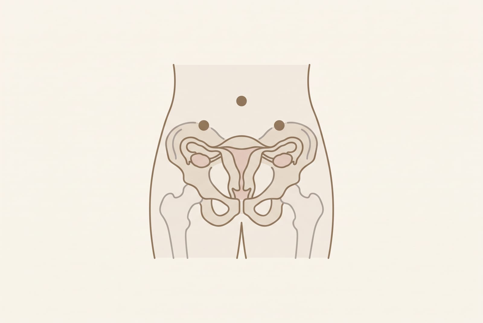 Ilustração explicativa do procedimento de videolaparoscopia