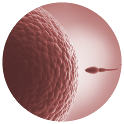 Ilustração explicativa da inseminação intrauterina